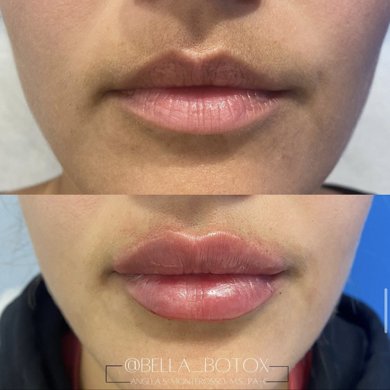 Juvederm Before and After Photo from Medique NYC in New York City
