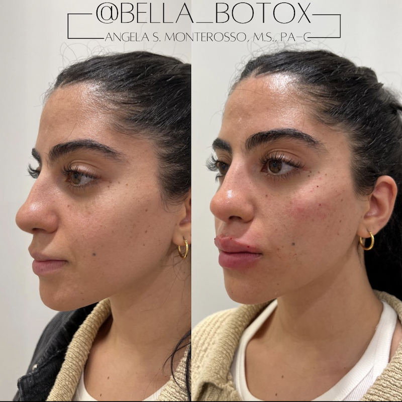 Juvederm Before and After Photo from Medique NYC in New York City