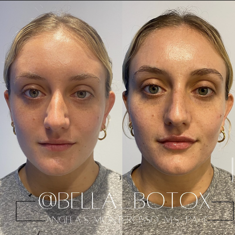Voluma Before and After Photo from Medique NYC in New York City